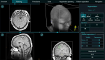 Neuronavigator: optical navigation system for neurosurgeons